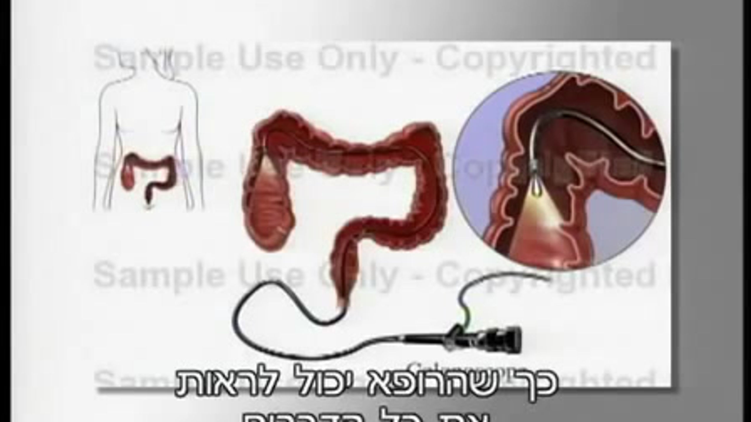 פרופ' רפי קרסו על בדיקת הקולונוסקופיה